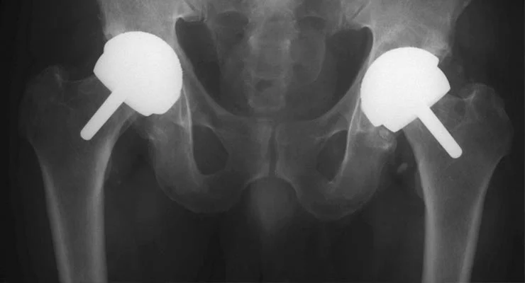 Is hip resurfacing a good alternative to hip replacement?