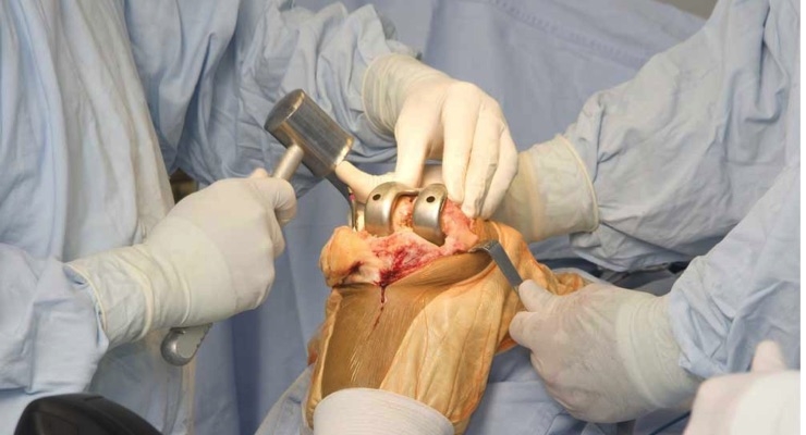 knee replacement blog